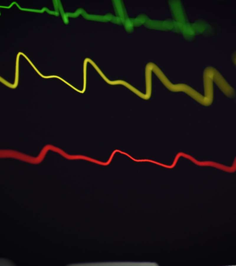 O eletrocardiograma ECG é um exame não invasivo e fundamental na avaliação da saúde cardíaca. Consiste no registo da atividade elétrica do coração, que per…