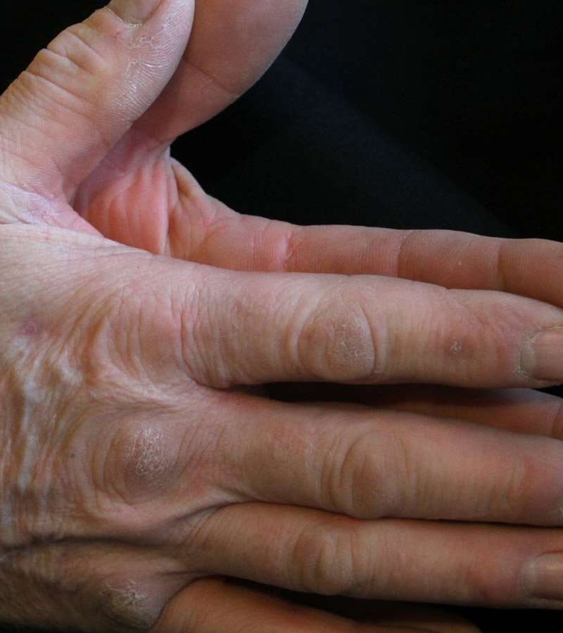 O formigueiro nas mãos e pés, medicamente conhecido como parestesia, é uma sensação descritiva de picadas, dormência ou ardor que pode surgir de forma súbi…