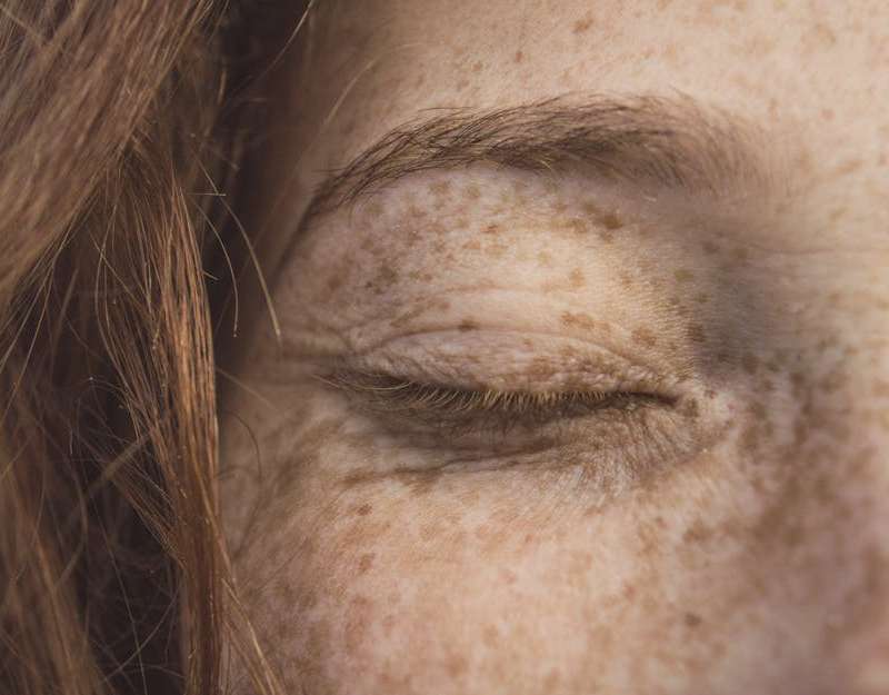Compreenda a queratose actínica: quais são os sinais, as opções de tratamento eficazes e como prevenir estas lesões cutâneas pré-malignas.